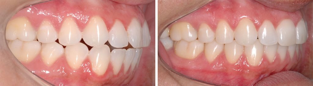 Invisalign x Aparelho Fixo