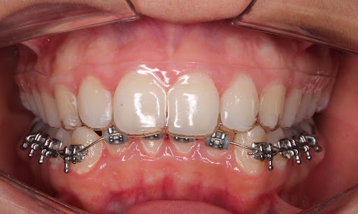 Invisalign x Aparelho Fixo