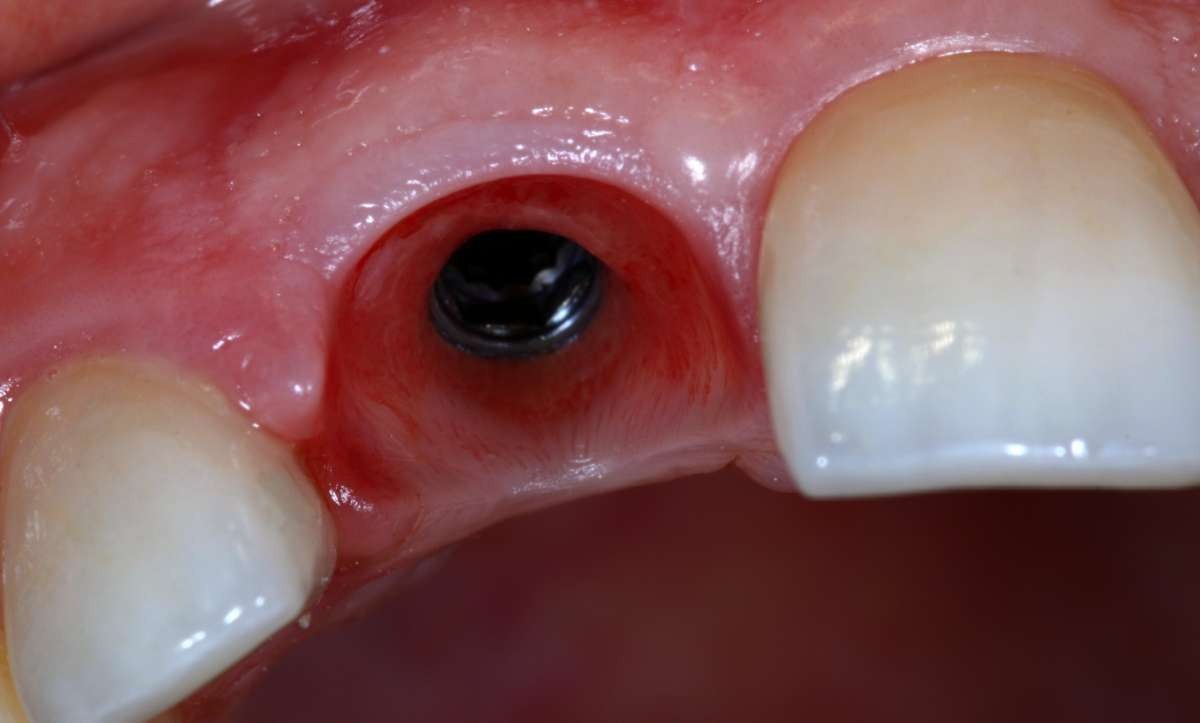 Preciso de um implante dentário?