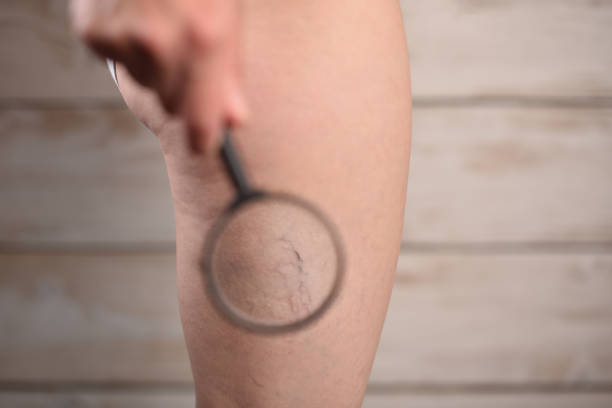 Alimentação e Varizes: Aliados e Vilões para a Saúde Vascular